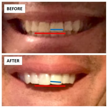 Sand Canyon Dental - IS THIS CROOKED? Or is it me? Their work they refused to fix. - General Dentistry Near Me - Irvine, California