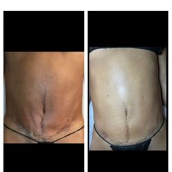 1st session vs 9th. This client had a tummy tuck + muscle repair done. Consistent, proper massages can truly aid in your healing process