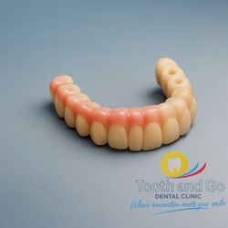 Tooth & Go Dental Clinic - All on 4 Bridge