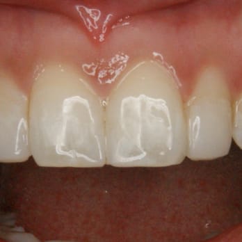 Anna K Choe, DDS - After bonding - General Dentistry Near Me - Pasadena, California