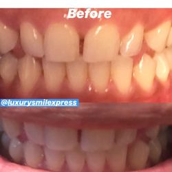 Before and after done by Luxury Smile Xpress.