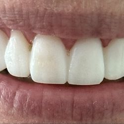 Boca Raton Cosmetic Dentist - Temporary crowns