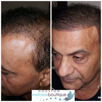 Houston Wellness Boutique - Scalp Micropigmentation - Permanent Makeup Near Me - Houston, Texas Houston Wellness Boutique - Scalp Micropigmentation - Permanent Makeup Near Me - Houston, Texas