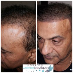 Houston Wellness Boutique - Scalp Micropigmentation