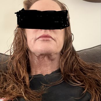 Ocean Plastic Surgery Center - 7 months post op- neck lift. Disappointed - Cosmetic Surgeons Near Me - Los Alamitos, California