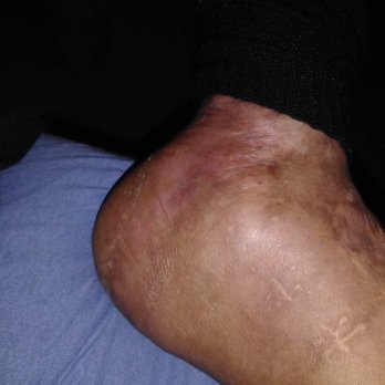 D. Miller & Associates - My husbands broken foot that he's been walking around in since December - Personal Injury Law Near Me - Houston, Texas D. Miller & Associates - My husbands broken foot that he's been walking around in since December - Personal Injury Law Near Me - Houston, Texas