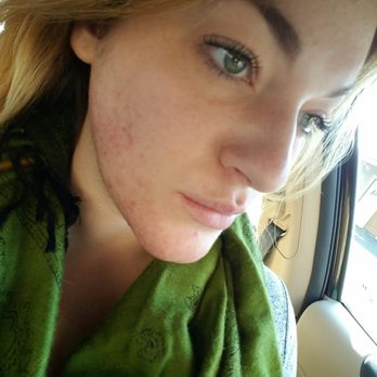 Blythe's Electrology Center - PCOS full face/neck service. This is immediately after a 1 hour appointment. The redness goes away after the first day or so. - Hair Removal Near Me - Roseville, California Blythe's Electrology Center - PCOS full face/neck service. This is immediately after a 1 hour appointment. The redness goes away after the first day or so. - Hair Removal Near Me - Roseville, California