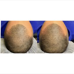 Westcoast Scalp Micropigmentation - Client wanted a subtle soft hairline ... exactly what he got