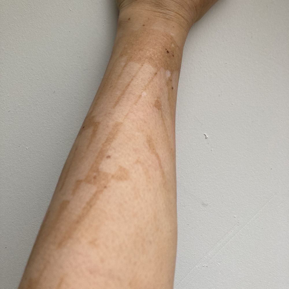 IPL from LaserAway Nov 2023 IPL from LaserAway Nov 2023