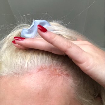 Moradi Studio - After 3 days of healing-- not even the half of it (this color is from me getting my hair redone he left my roots orange) - Hair Salons Near Me - Santa Monica, California