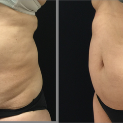 Tram Nguyen, MD - BellaGia MD - Tram Nguyen, MD's Patient C(ABDOMEN):Before and 8 weeks after first session