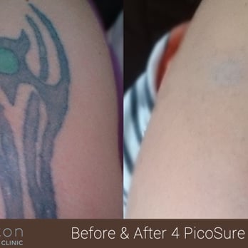 Andrea Catton Laser Clinic - PicoSure laser tattoo removal on upper arm. 4 treatments - Laser Hair Removal Near Me - Burnley, LAN
