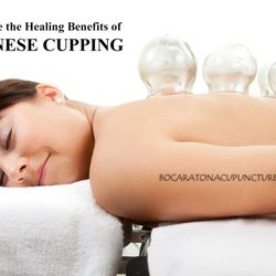 Boca Raton Acupuncture - More mainstream than ever, Chinese Cupping is a great way to relieve pain and recover from workouts