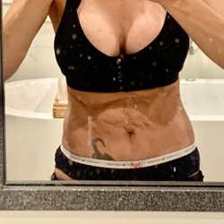 Brantley Shelby K Jr MD - After botched tummy tuck by Dr Shelby Brantley