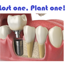Loza Dental Great Falls - We do implants!!