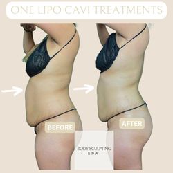 Body Sculpting Academy - Lipo Cavi