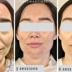 Greg Martin Skin - Greg Martin Skin's customized Microcurrent Therapy: skin texture, acne, under eye area, and muscle training