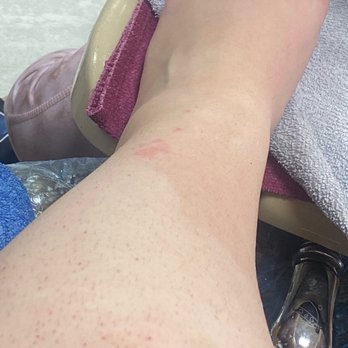 Polished Nail Bar - Leg burned - Nail Salons Near Me - Brooksville, Florida Polished Nail Bar - Leg burned - Nail Salons Near Me - Brooksville, Florida