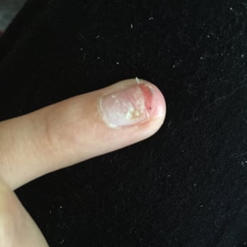 Lee Nails - Extremely painful and YES THAT IS FUNGUS !! Unsanitary and disgusting. - Nail Salons Near Me - Kissimmee, Florida
