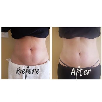 Mary J Skin - Body Contouring 1st Treatment - Skin Care Near Me - Los Angeles, California Mary J Skin - Body Contouring 1st Treatment - Skin Care Near Me - Los Angeles, California