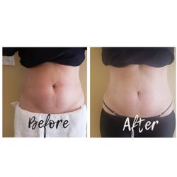 Mary J Skin - Body Contouring 1st Treatment