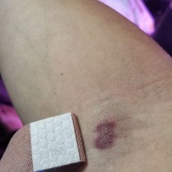 Quest Diagnostics - First time experiencing pain throughout when getting blood drawn. Bruised immediately.
