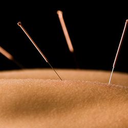 Norfolk Acupuncture