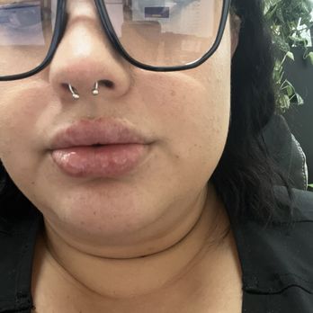 Flawless Lips - Minimal bruising - Teeth Whitening Near Me Flawless Lips - Minimal bruising - Teeth Whitening Near Me