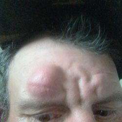 Center For Facial Appearances - I was attacked by a mental man and hit by my own walking cane.