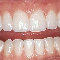 Bright Now Dental & Orthodontics - My friends teeth before