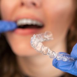 Diamond Braces
