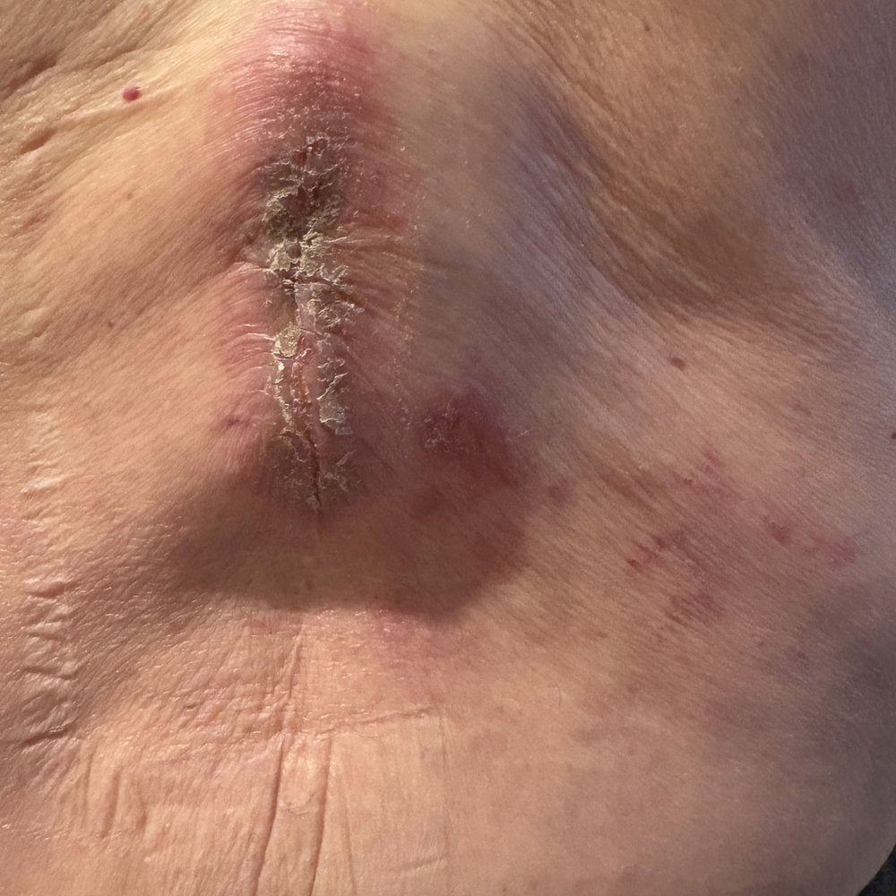 Kenneth Bermudez, MD - Cystoma Before - Medical Spas Near Me - San Francisco, California