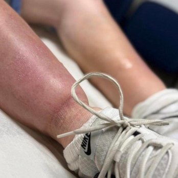 Vein Treatment Center - Vascular Medicine Near Me - Williamsville, New York Vein Treatment Center - Vascular Medicine Near Me - Williamsville, New York