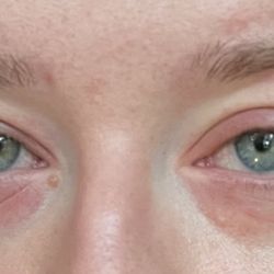 TPMG Coastal Allergy