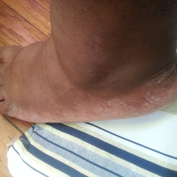 A Nail Today - I've never left a salon with my foot looking like this. Just flaky skin everywhere. I paid $23 for this??? - Nail Salons Near Me - Oakland, California A Nail Today - I've never left a salon with my foot looking like this. Just flaky skin everywhere. I paid $23 for this??? - Nail Salons Near Me - Oakland, California