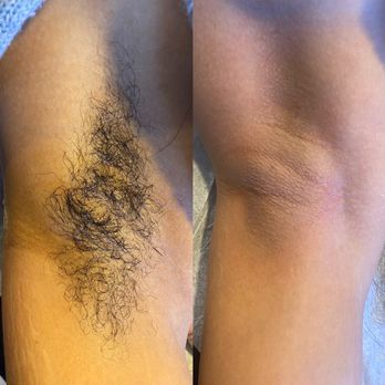 Trifecta Studios - Underarms before and after - Waxing Near Me - Kansas City, Missouri