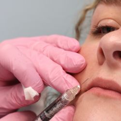 Skin & Sculpt Medical Spa - Juvederm $50 off each syringe in May 2026!