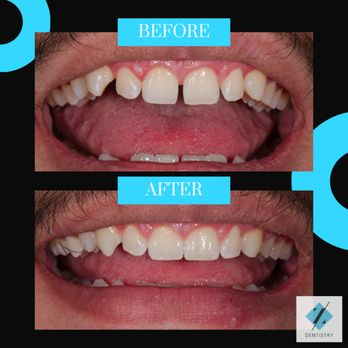 Z Dentistry - Before and after Invisalign - General Dentistry Near Me - Northlake, Texas