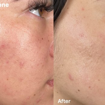 Next Level Med Solutions - HydraFacial before and after photo on blemish prone skin. - Medical Spas Near Me - Plano, Texas