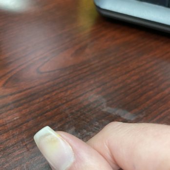 Venetian Nails - Nails with fungus after a dip powder manicure at this salon - Nail Salons Near Me - Weston, Florida Venetian Nails - Nails with fungus after a dip powder manicure at this salon - Nail Salons Near Me - Weston, Florida
