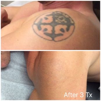 Marta Recasens MediSpa - Tattoo Removal Near Me - Glendale, California Marta Recasens MediSpa - Tattoo Removal Near Me - Glendale, California