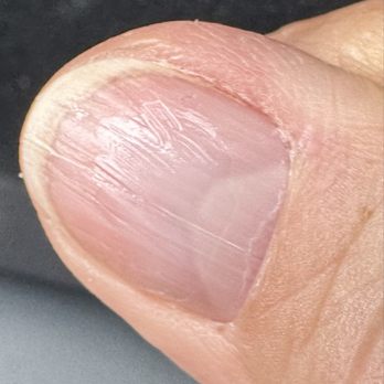 The Nail Box - Gouged nails from no-chip removal - Nail Salons Near Me - Suffolk, Virginia The Nail Box - Gouged nails from no-chip removal - Nail Salons Near Me - Suffolk, Virginia