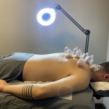 KV Acupuncture. - Cupping - Acupuncture Near Me - Buford, Georgia KV Acupuncture. - Cupping - Acupuncture Near Me - Buford, Georgia