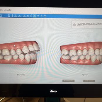 Silva Orthodontics - Initial scan of possible before and after - Orthodontists Near Me - Burbank, California