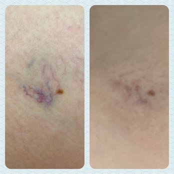 Luminous Laser - Spider vein removal before and immediately after treatment. Full results 2-3 weeks post treatment. - Laser Hair Removal Near Me - Scottsdale, Arizona Luminous Laser - Spider vein removal before and immediately after treatment. Full results 2-3 weeks post treatment. - Laser Hair Removal Near Me - Scottsdale, Arizona