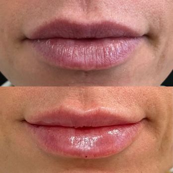 Urban Radiance - Lip filler - Medical Spas Near Me - Frederick, Colorado Urban Radiance - Lip filler - Medical Spas Near Me - Frederick, Colorado