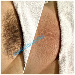 Perfect Beauty Bar - Before and after Brazillian wax done by Parveen !