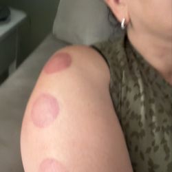 Juanito El Sobador - Cupping therapy