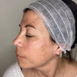 Smooth Skin Centers - Before Moxi Laser