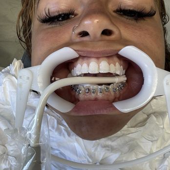LA Dental Braces - General Dentistry Near Me - Los Angeles, California LA Dental Braces - General Dentistry Near Me - Los Angeles, California